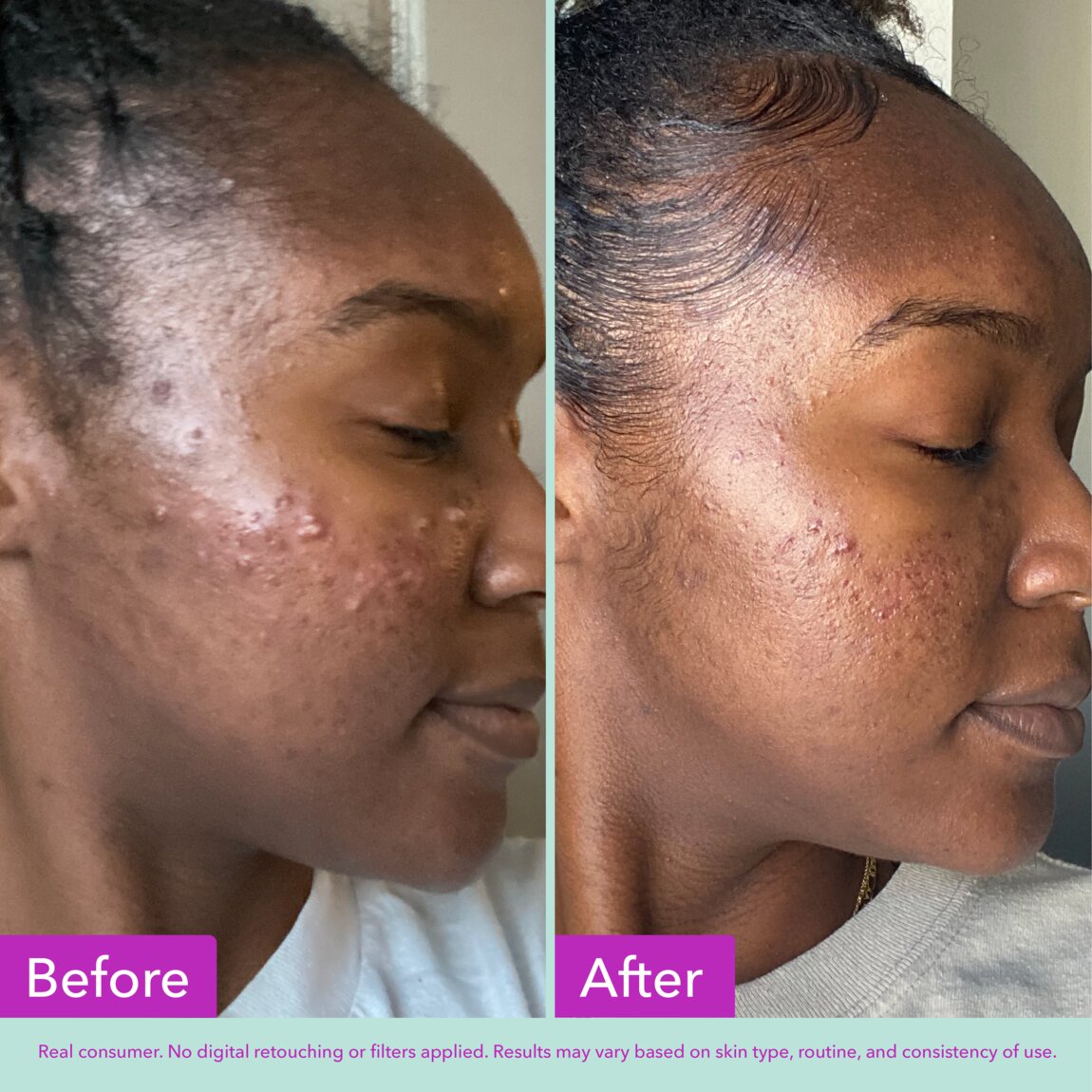 acne-foaming-cleanser-l6 zb_p.jpg