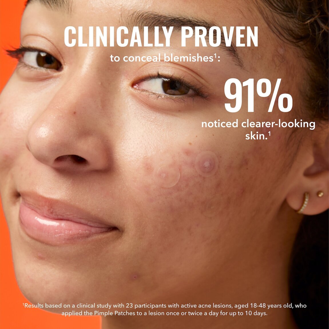 pimple-patches-e5 zb_p.jpg